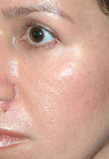 FAT TRANSFER - Patient - After